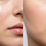Before and after images showing hydrocolloid acne pimple treatment results on facial skin, demonstrating how it reduces inflammation and speeds up healing.